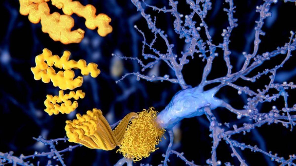 Alzheimer araştırmasında skandal!