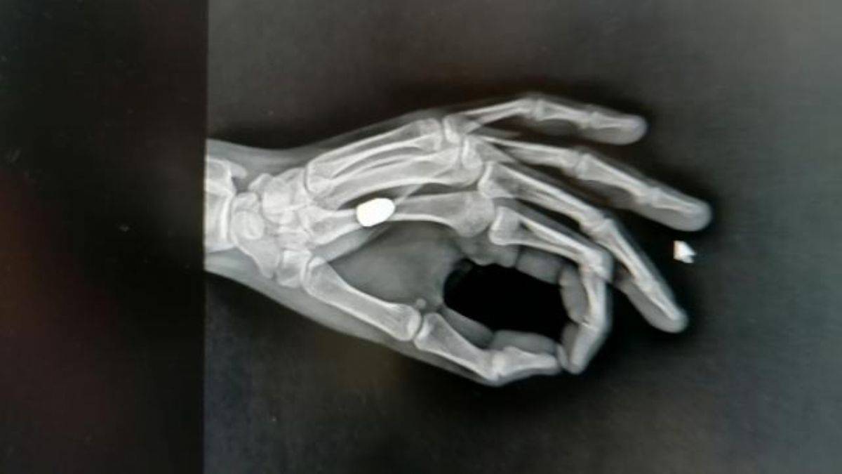 Eline taş düştü sandı, yorgun mermi çıktı