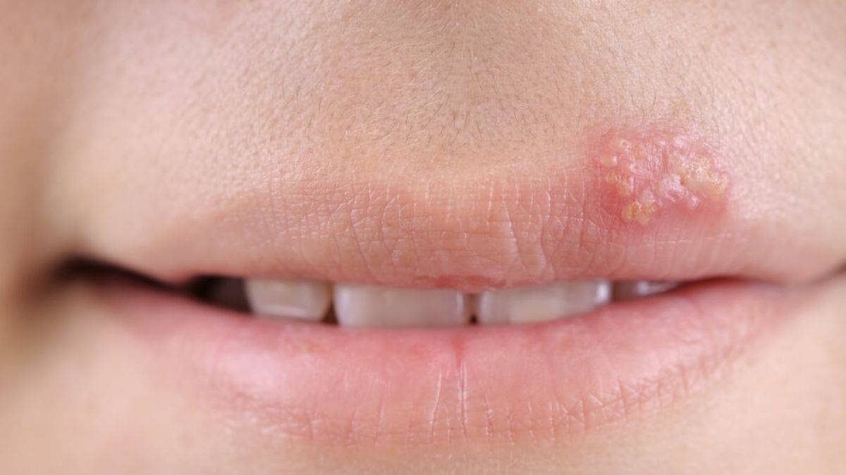 Herpes virüsü, Tip 2 diyabet riskini artırabiliyor