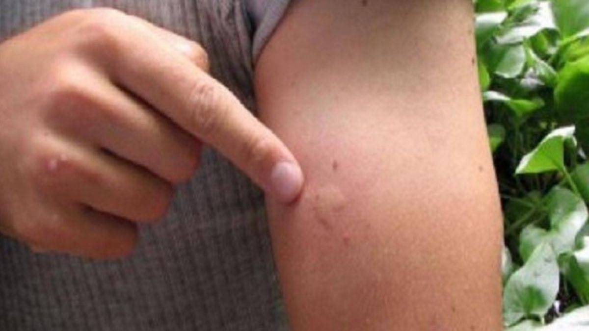 Batı Nil Virüsü nedir? Batı Nil Virüsü belirtileri nedir, nasıl bulaşır?