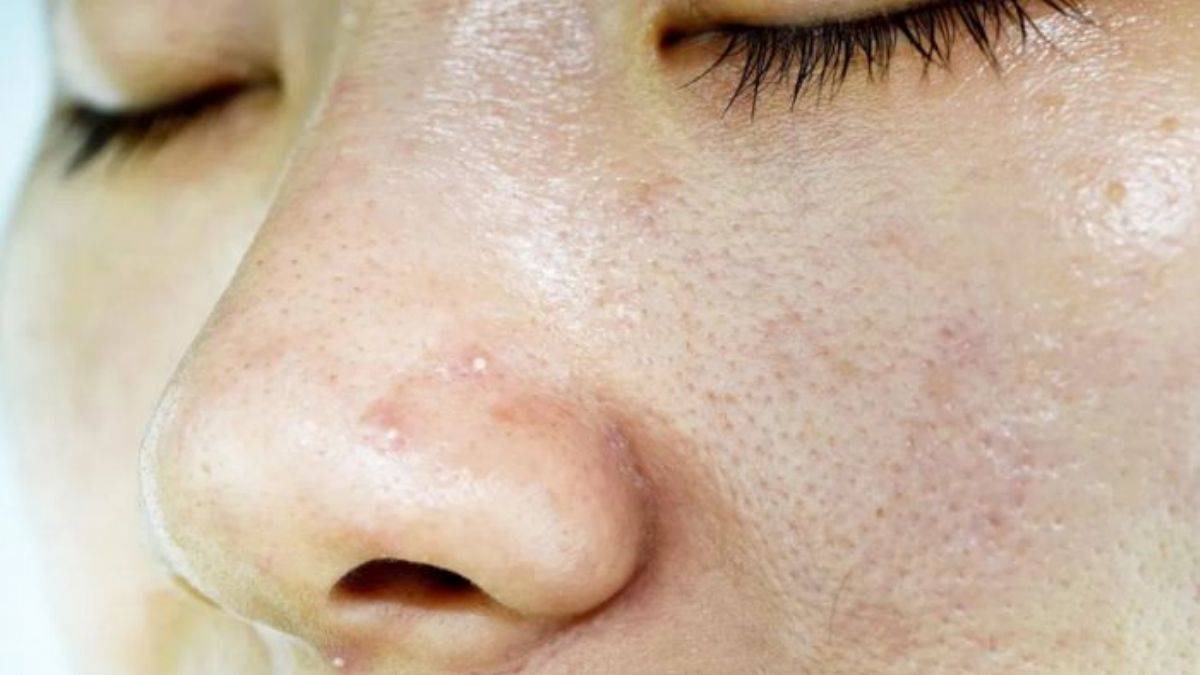 Burun yağlarına çözüm! Yağlı burun için doğal bakım | Burun yağları nasıl giderilir? Burun yağı neden oluşur?