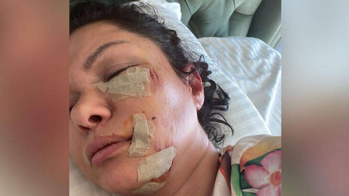 Köpek saldırısına uğrayan şarkıcı Tuğba Altıntop'un yüzüne dikiş atıldı