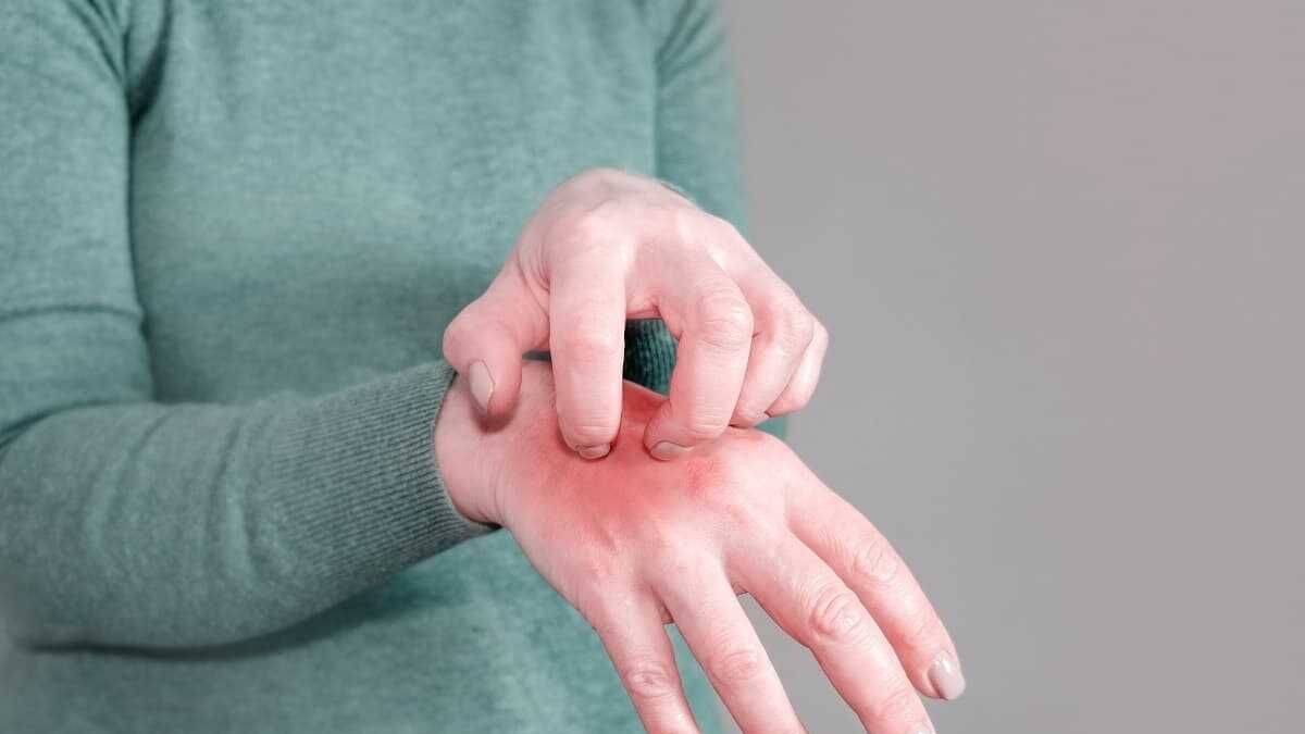 Dünyada uyuz vakalarında artış!