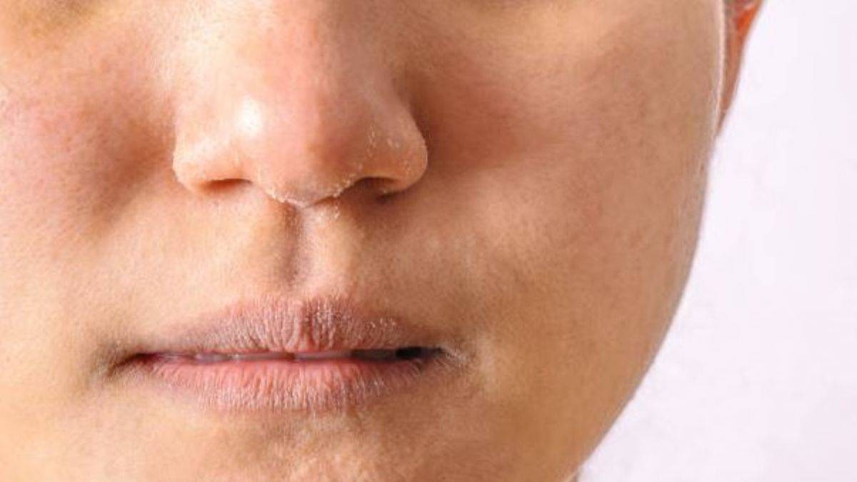 Cilt kuruluğu neden olur? Kuruluk hangi vitamin eksikliğinden olur? El, yüz ve dudakların kurumasının nedenleri