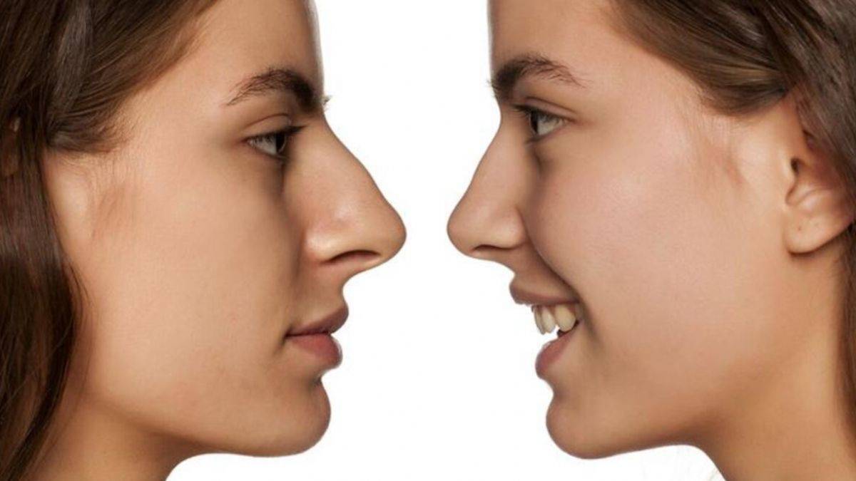 Burun Estetiği Operasyonunda Dikkat Çeken Noktalar