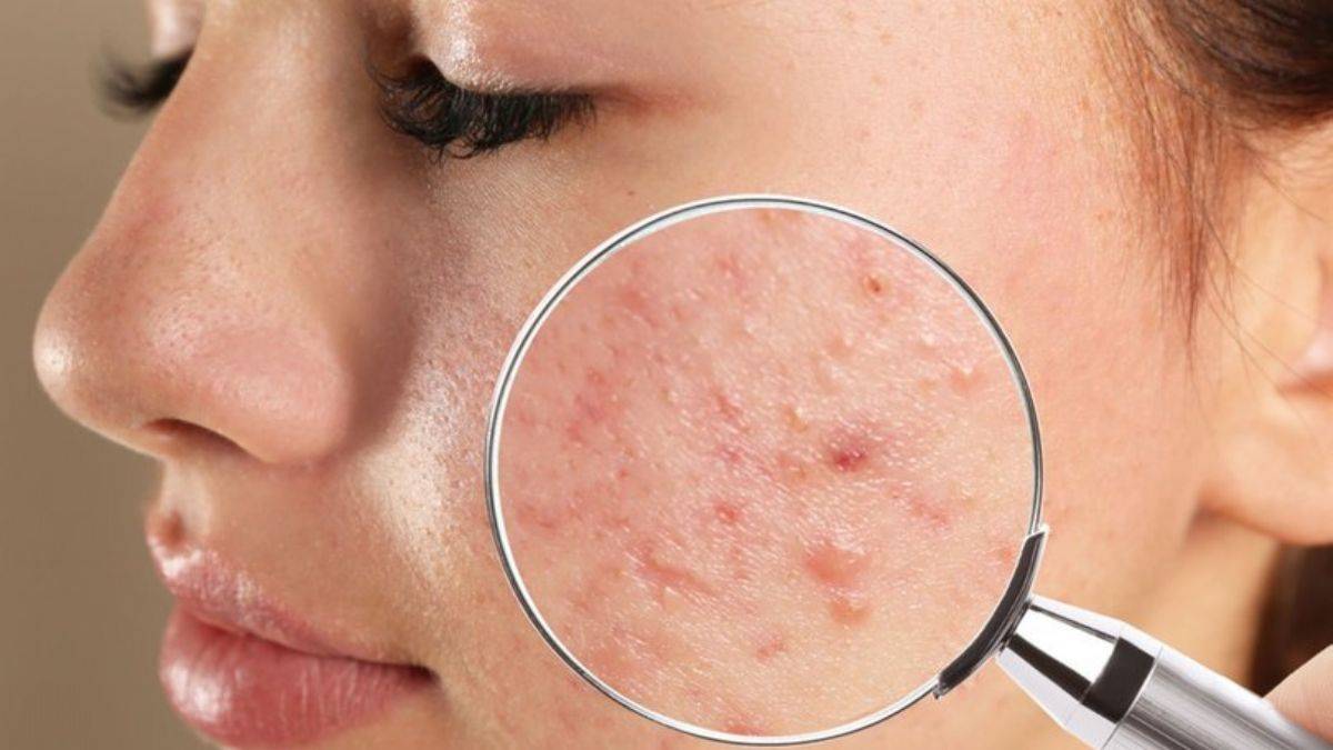 Sivilce neden olur? Hangi yiyecekler sivilce yapar? Süt ve süt ürünleri sivilce yapar mı? Sivilce hangi yaşta çıkar? Sivilce (akne) tedavisi