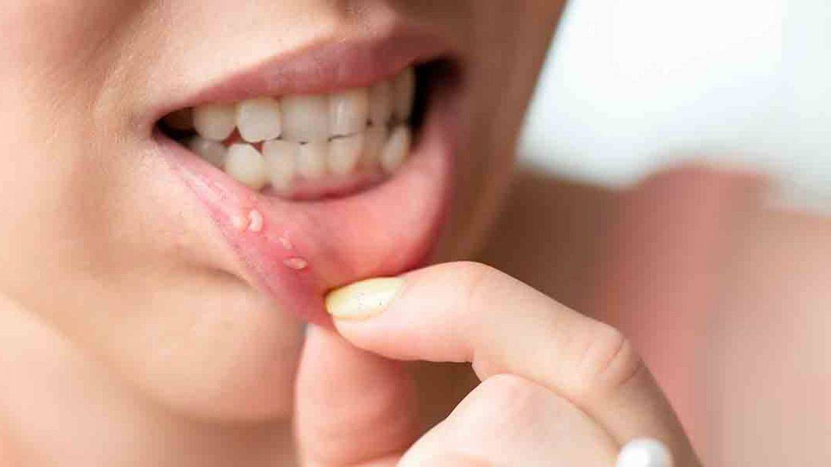 Aft nedir, neden olur? Aft yarasını geçiren gargara I Sumak afta iyi geliyor mu