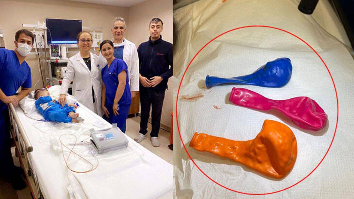 1 yaşındaki bebeğin midesinden 3 balon çıkarıldı