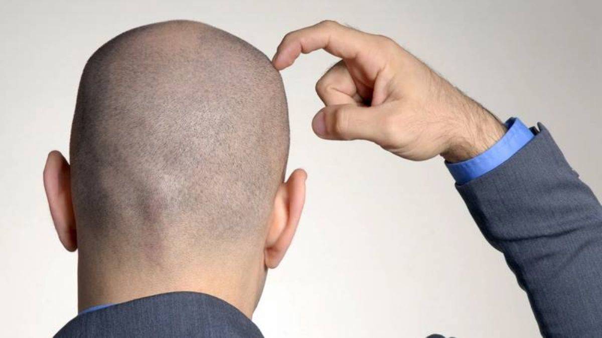 Kellik tarih mi oluyor? Laboratuvarda saç üretildi