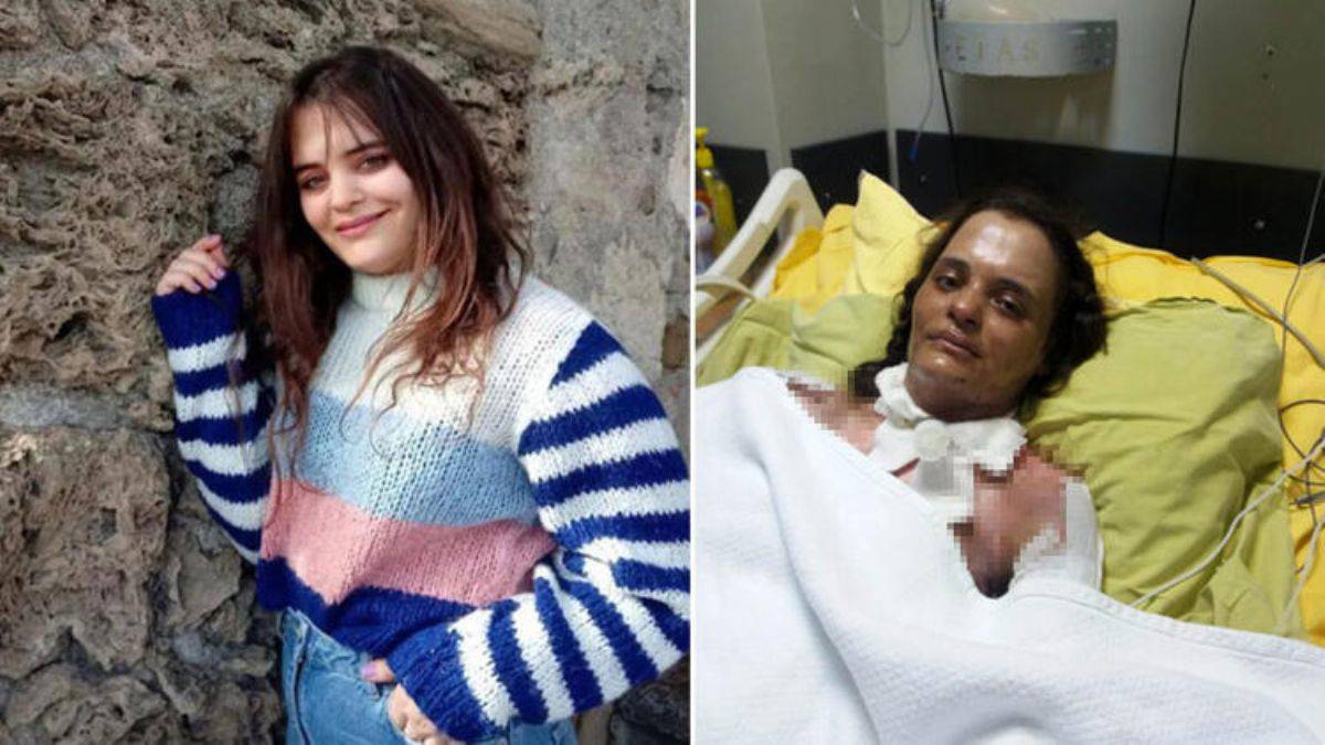 Dezenfektanın parlamasıyla yanan Havva, 75 gündür yoğun bakımda