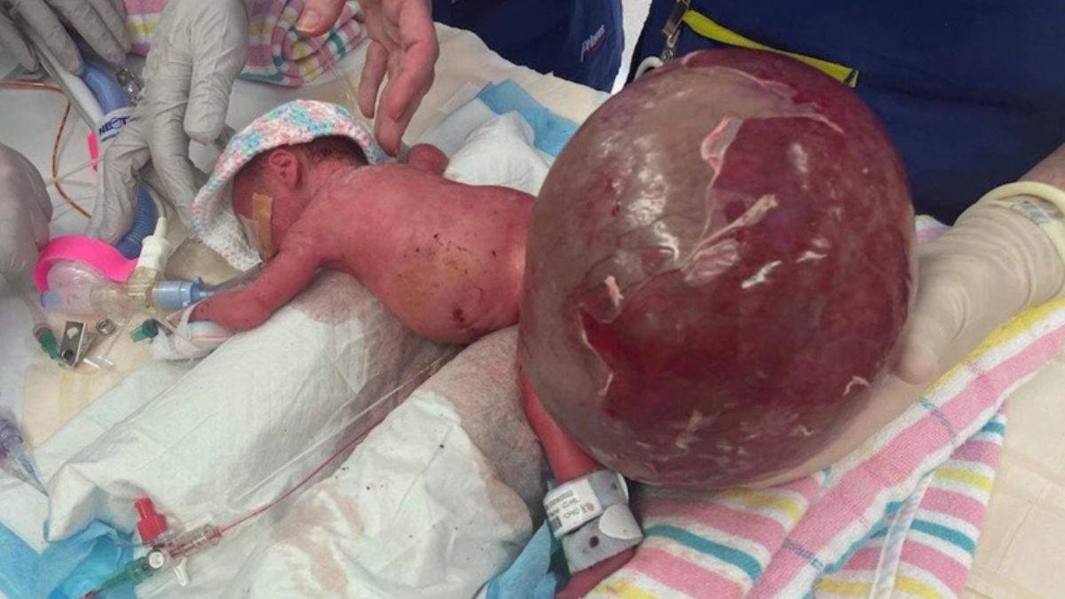 Mucize bebek! Kendisinden iki kat büyük tümörle doğdu, hayata tutundu
