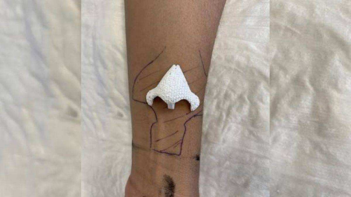 Kanserli kadın kolunda yeni bir burun büyüttü