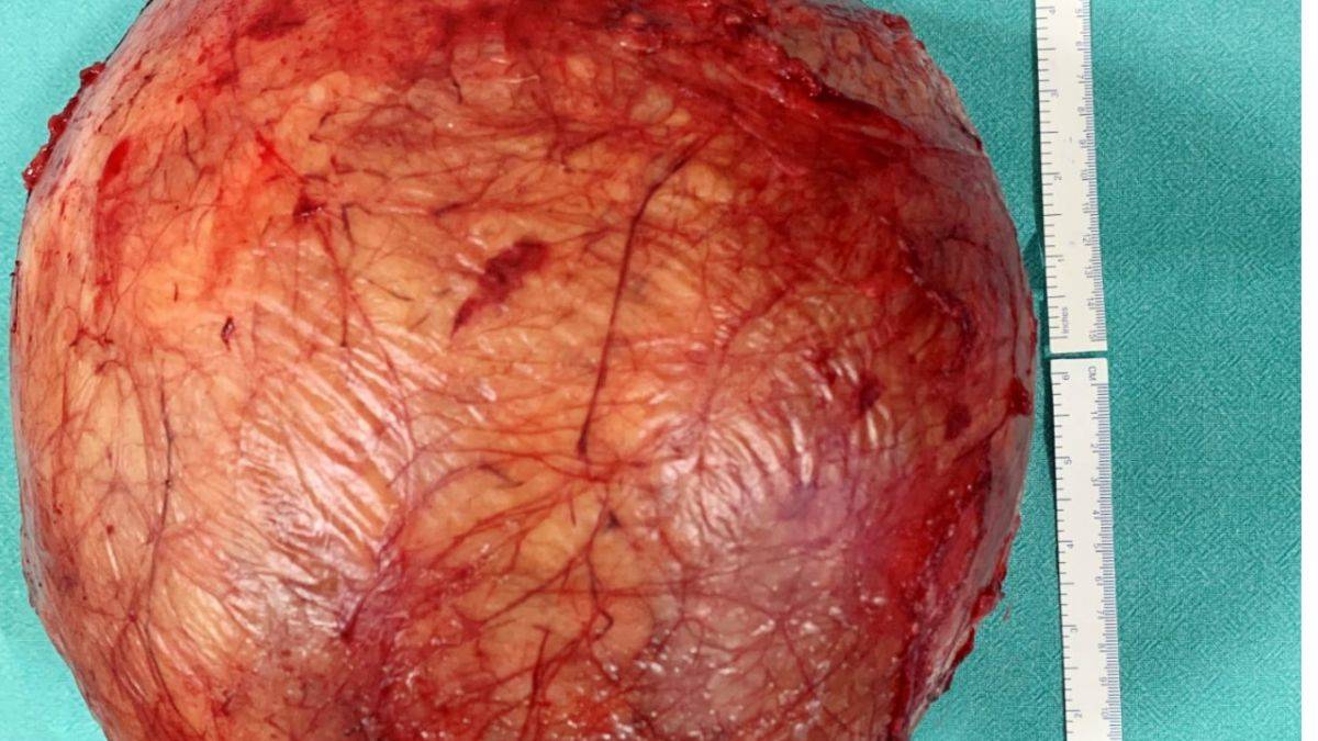 Midesinden futbol topu büyüklüğünde tümör çıkarıldı