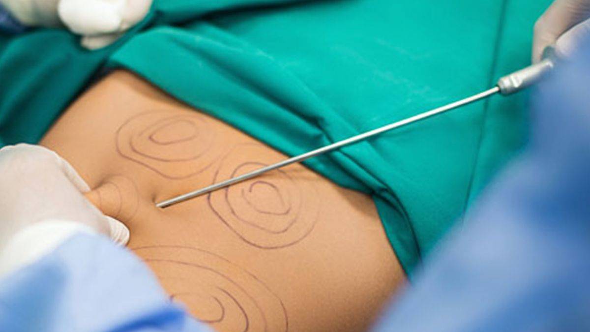 Liposuction Nedir? Kimlere Uygulanır?