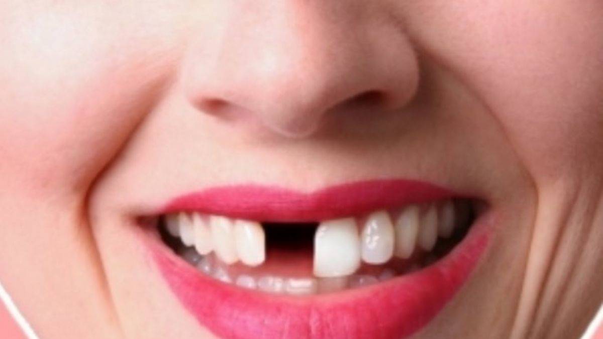 Rüyada Diş Dökülmesi Ne Anlama Gelir?