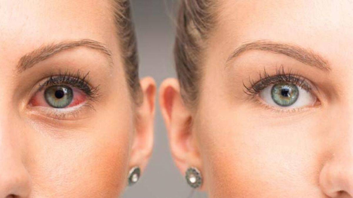 Adenovirüs vakaları hızla artıyor: Kalıcı görme bozukluğuna yol açabilir