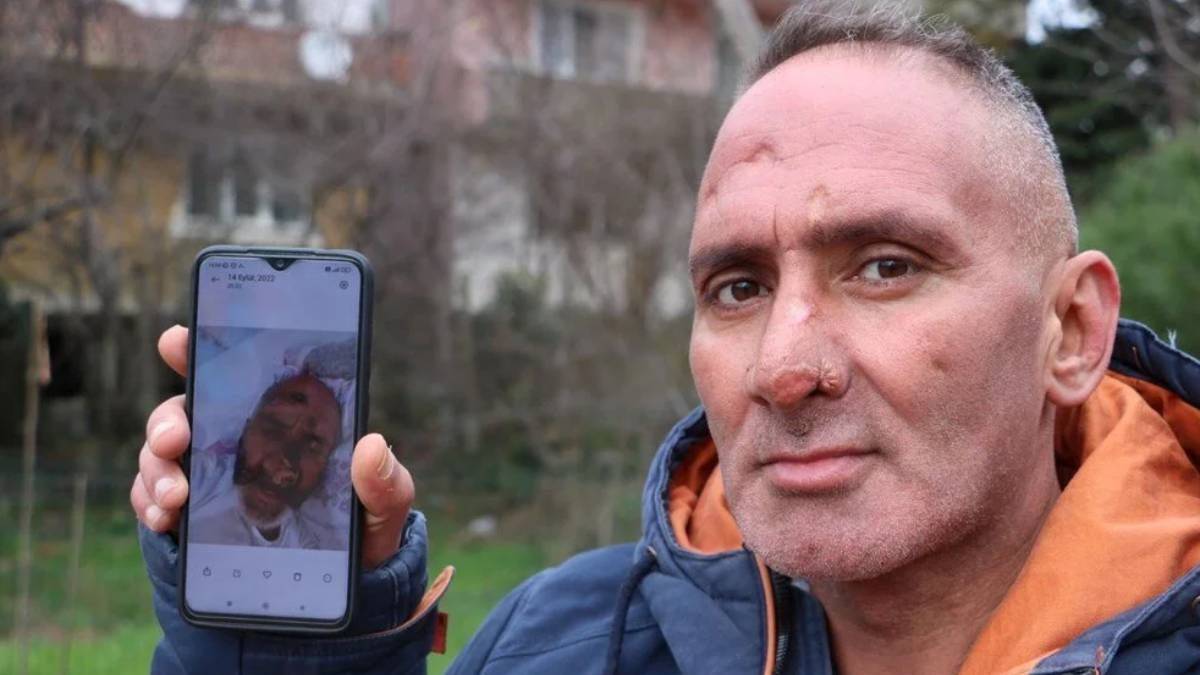 Layşmanyaz nedir, nasıl bulaşır?