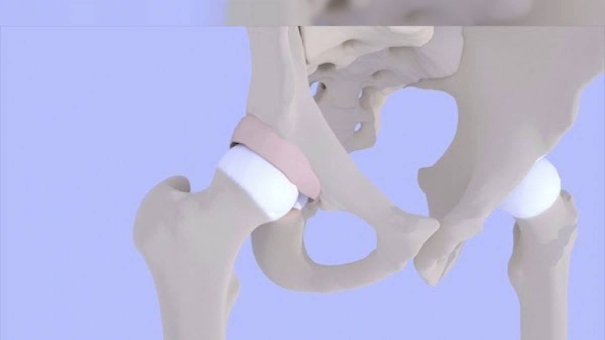 Kalça Sıkışma Sendromu