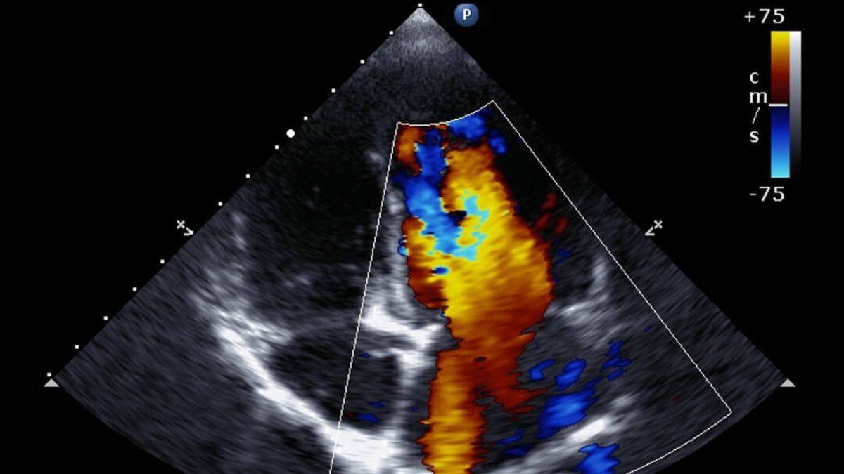 Renkli Doppler Ultrason Nedir?