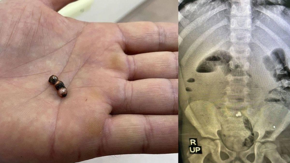 7 yaşında dehşeti yaşadı! Bağırsaklara yapışan oyuncak az kalsın çocuğu canından edecekti