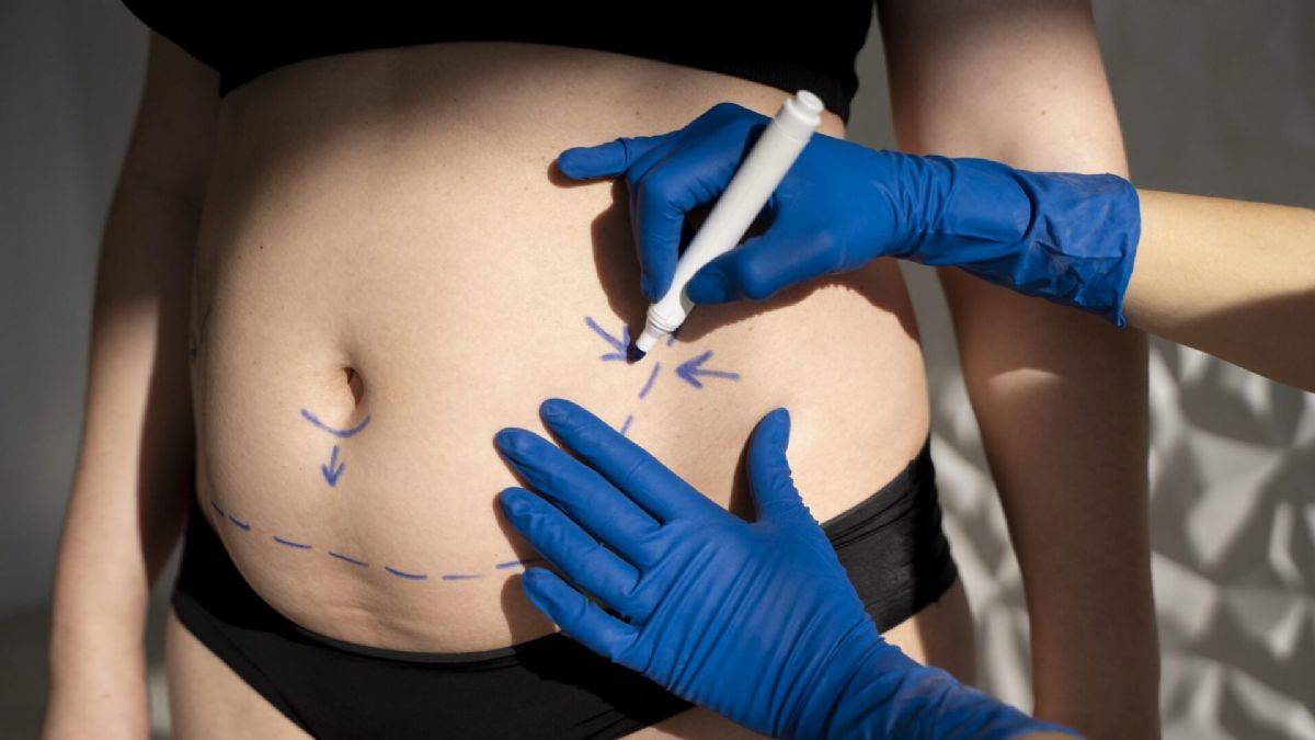 Karın Germe Ameliyatı (Abdominoplasty)