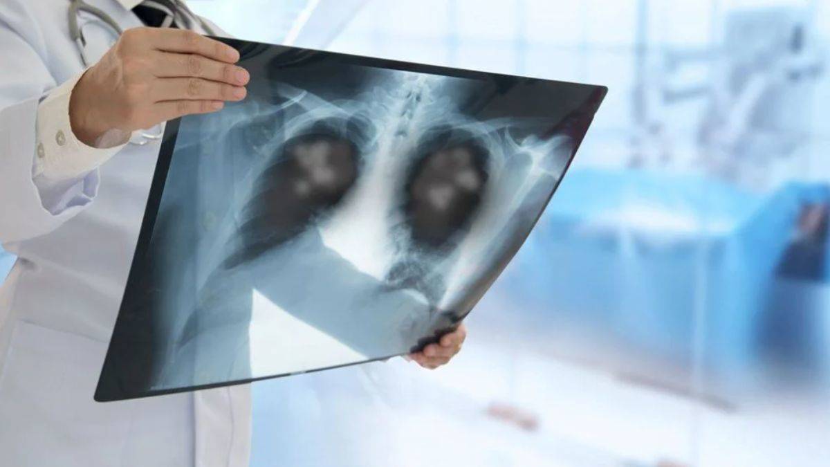 Basit parmak testiyle akciğer kanseri riski öğrenilebilir