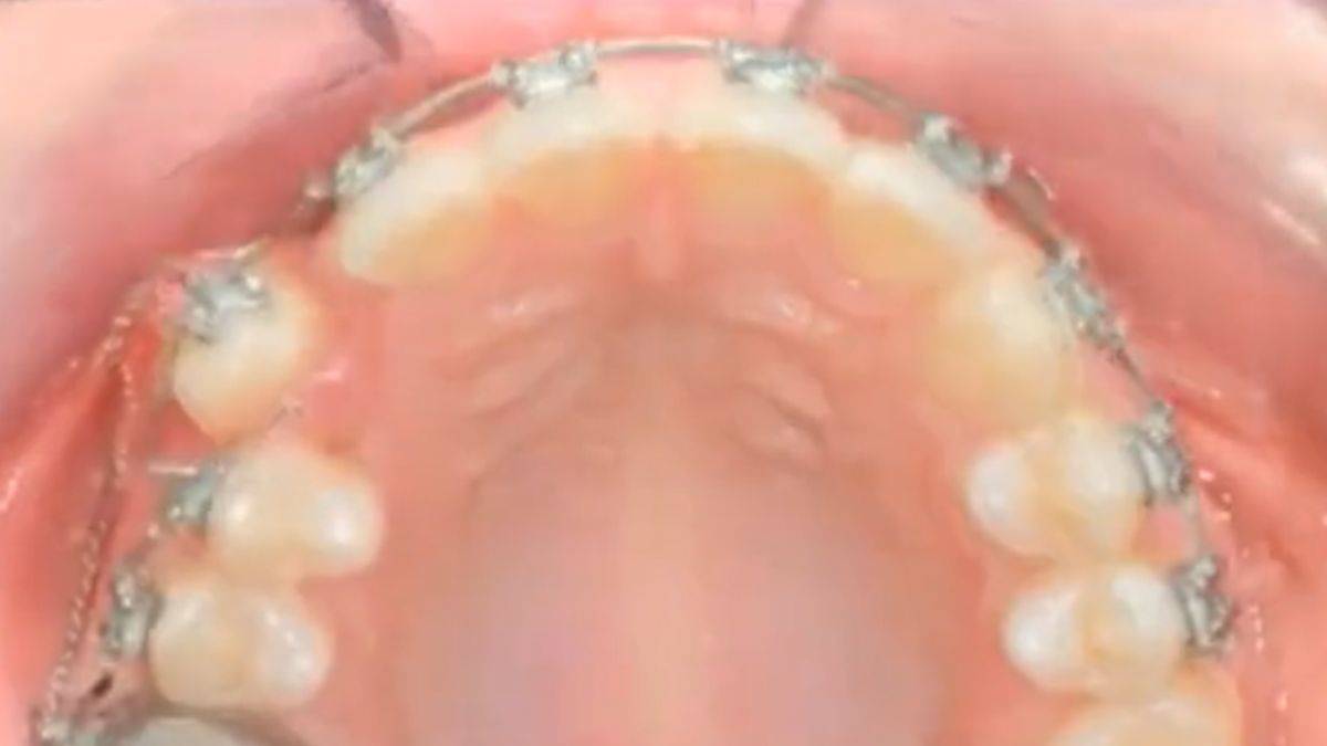 Diş telleri dişleri nasıl düzeltiyor?