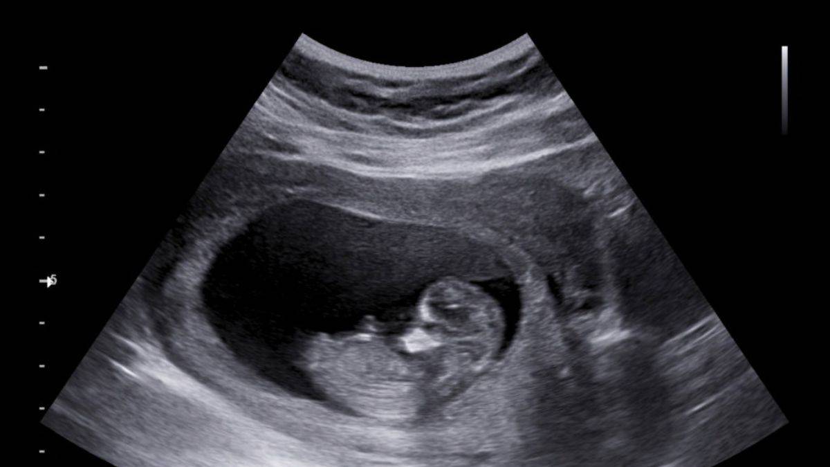 Şizofreni, anne karnındayken ortaya çıkıyor