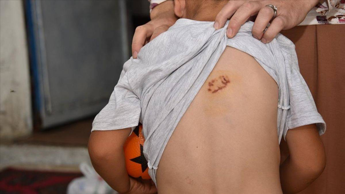 3 çocuğa daha köpek saldırdı