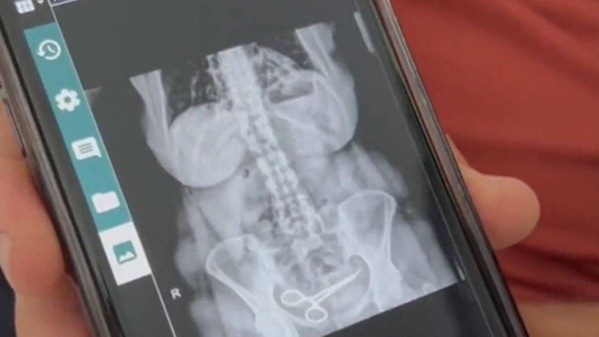 Doktorlar karnında makas unuttu!