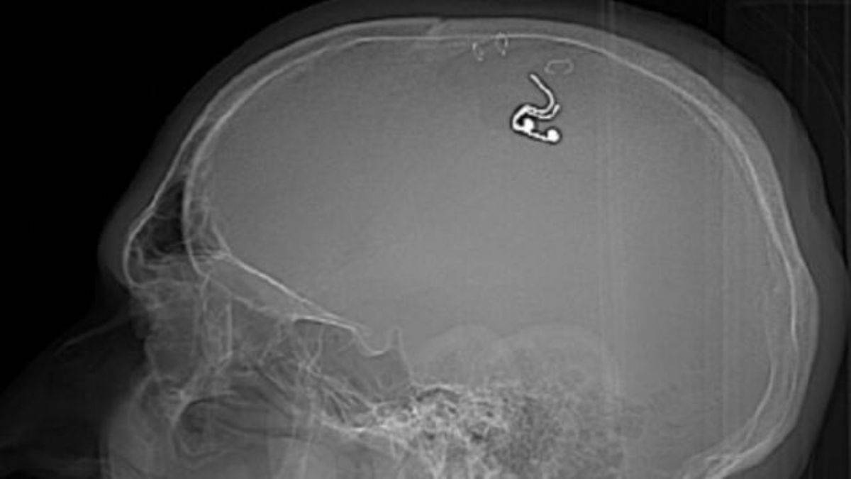 Rüyalarını kontrol etmek için matkapla kafasını deldi