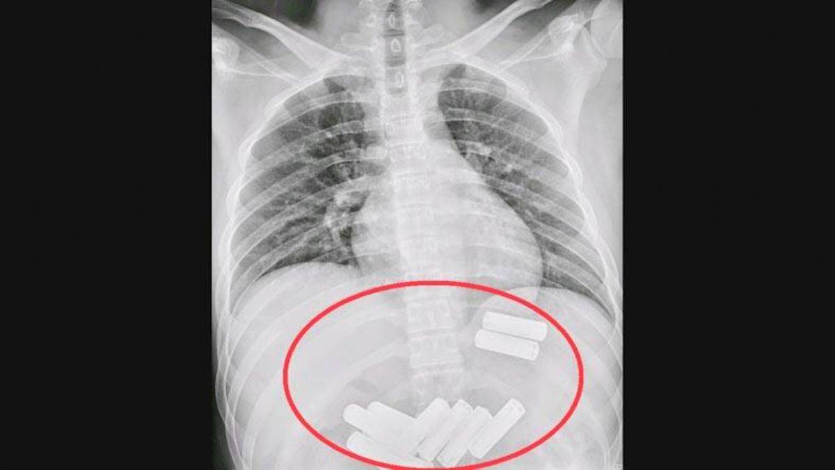 11 pil yutan Çinli: Canım çok yandı