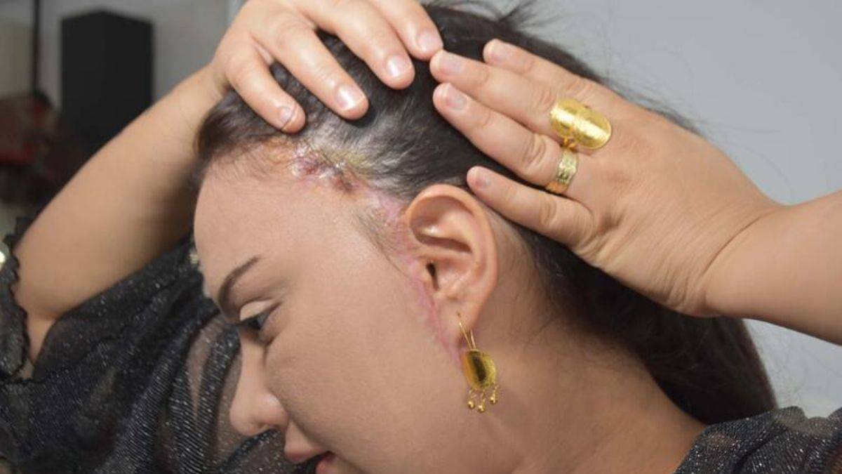 'Badem göz' ameliyatı hayatını kararttı