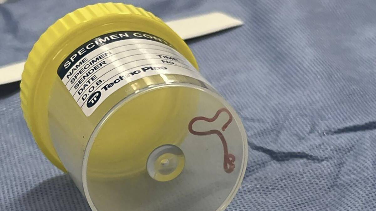 Yaşlı kadının beyninden canlı solucan çıkarıldı