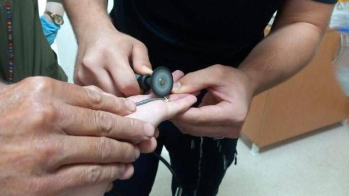 Parmağına sıkışan yüzük kesilerek çıkarıldı