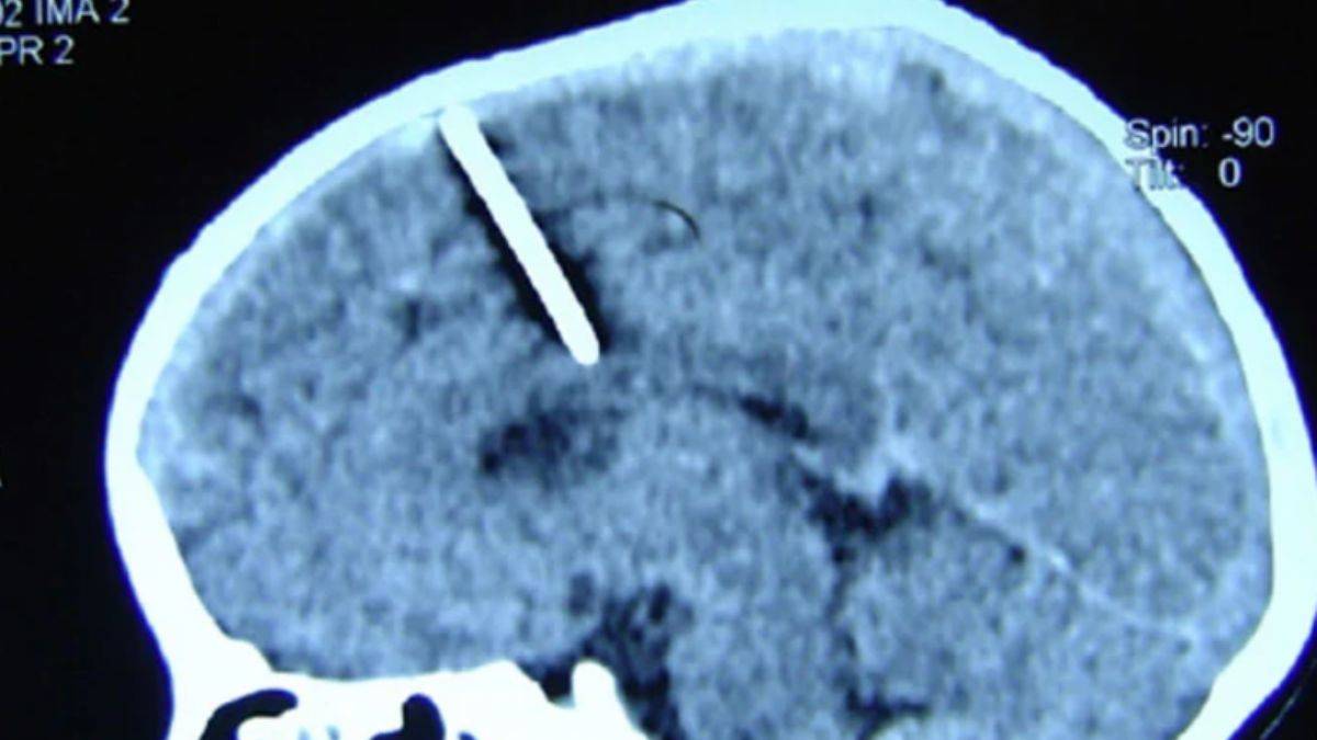 80 yıl boyunca beynine saplı iğneyle yaşadı