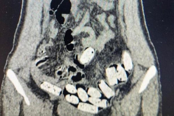 Bağırsakta uyuşturucu ticareti! 3 İranlı kadın tutuklandı