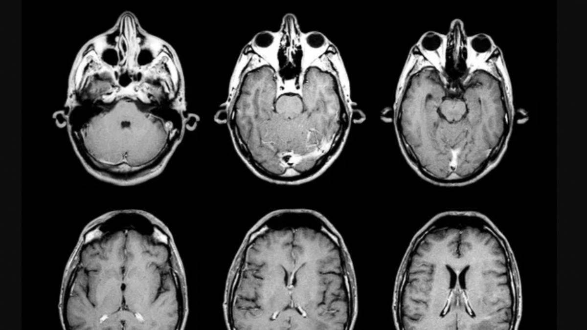 Doktorlara yeni 'beyin ölümü' kılavuzu