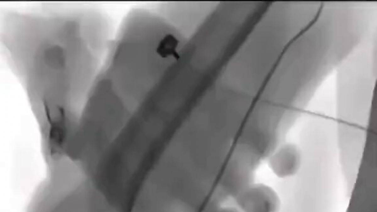 Anjiyo prosedüründe damar erişiminde kritik rol oynayan dışardan manevralar