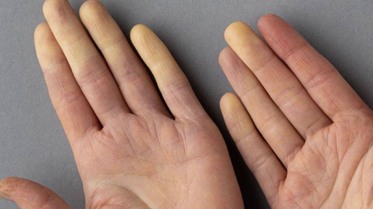 Raynaud sendromu nedir ve hangi hastalıklarda görülür?