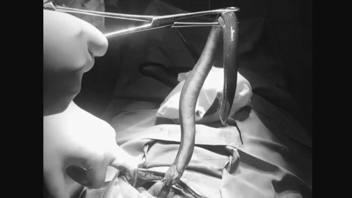 Vücudundan ameliyatla canlı yılan balığı çıkarıldı