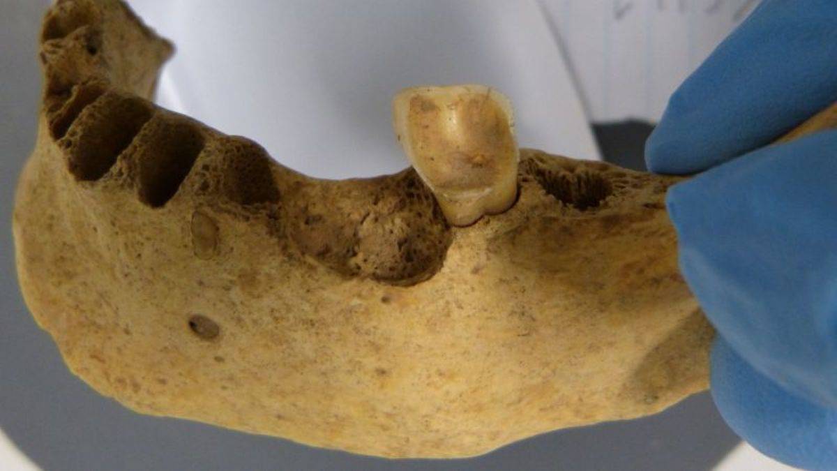 4 bin yıl önceki diş çürüğü ve sebebi keşfedildi