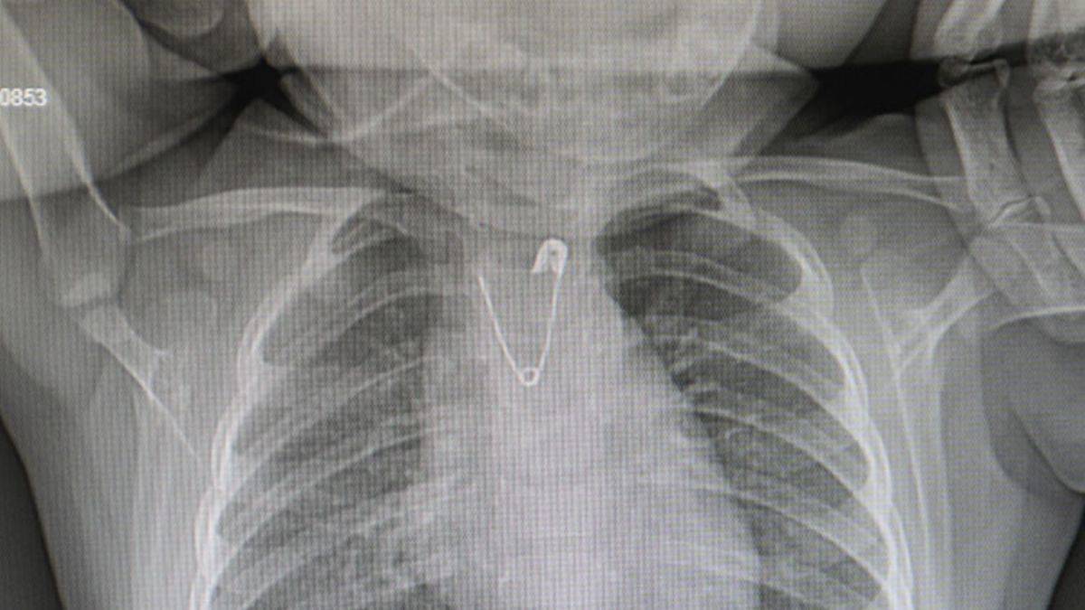 10 aylık bebek çengelli iğne yuttu