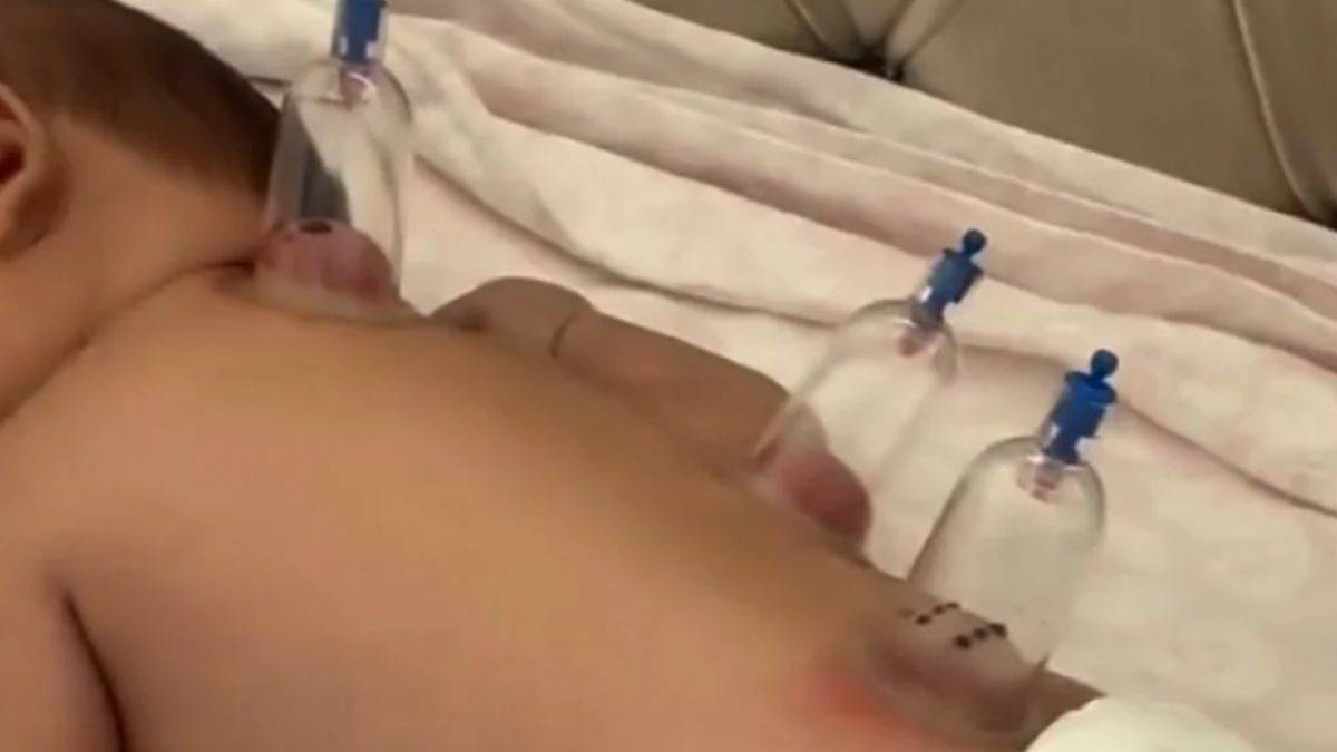 Sosyal medyada bebeklere hacamat tartışması