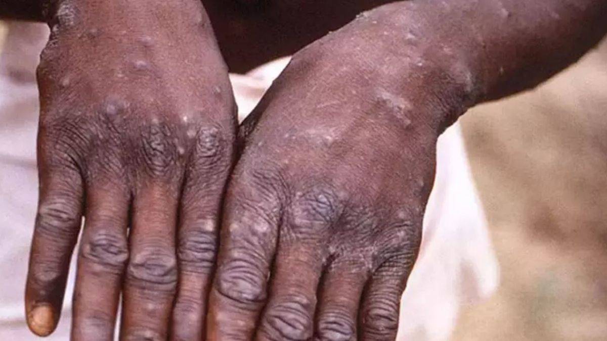 Maymun Çiçeği Türkiye'de Tespit Edildi Mi? Sağlık Bakanlığı'ndan Açıklama