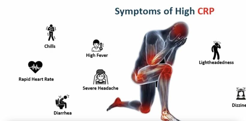 CRP yüksekliği ne anlama gelir, belirtileri nelerdir? C- Reaktif Protein nedir, nasıl düşer nasıl yükselir?