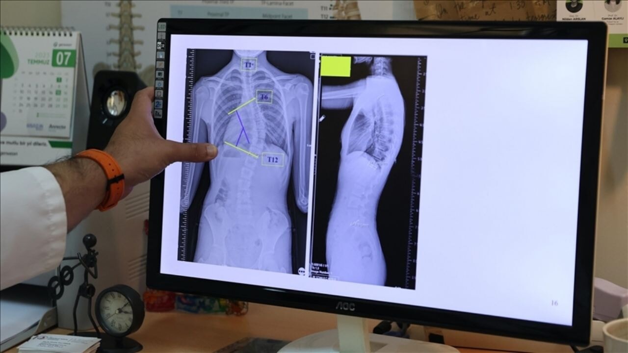 Her ergen kızda görülebilir: Skolyoz nedir? Nasıl tedavi edilir?