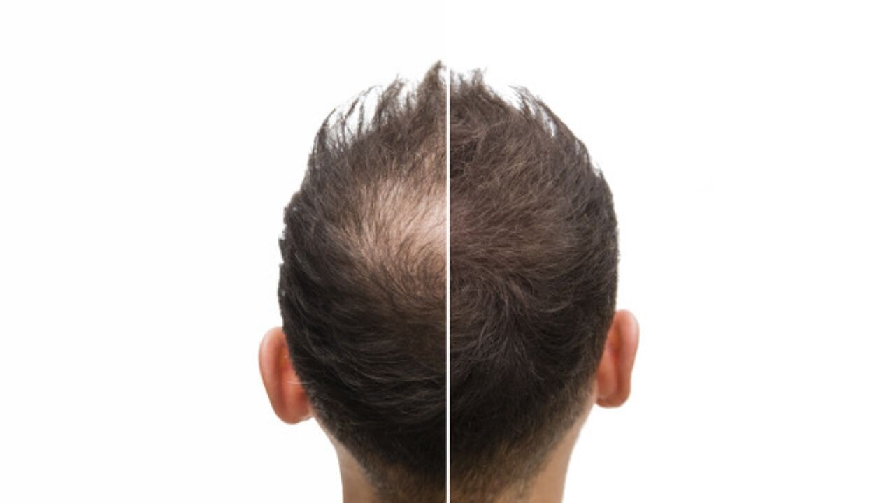 Saç Ekiminden 9 Ay Sonra Kimse Tanıyamadı!