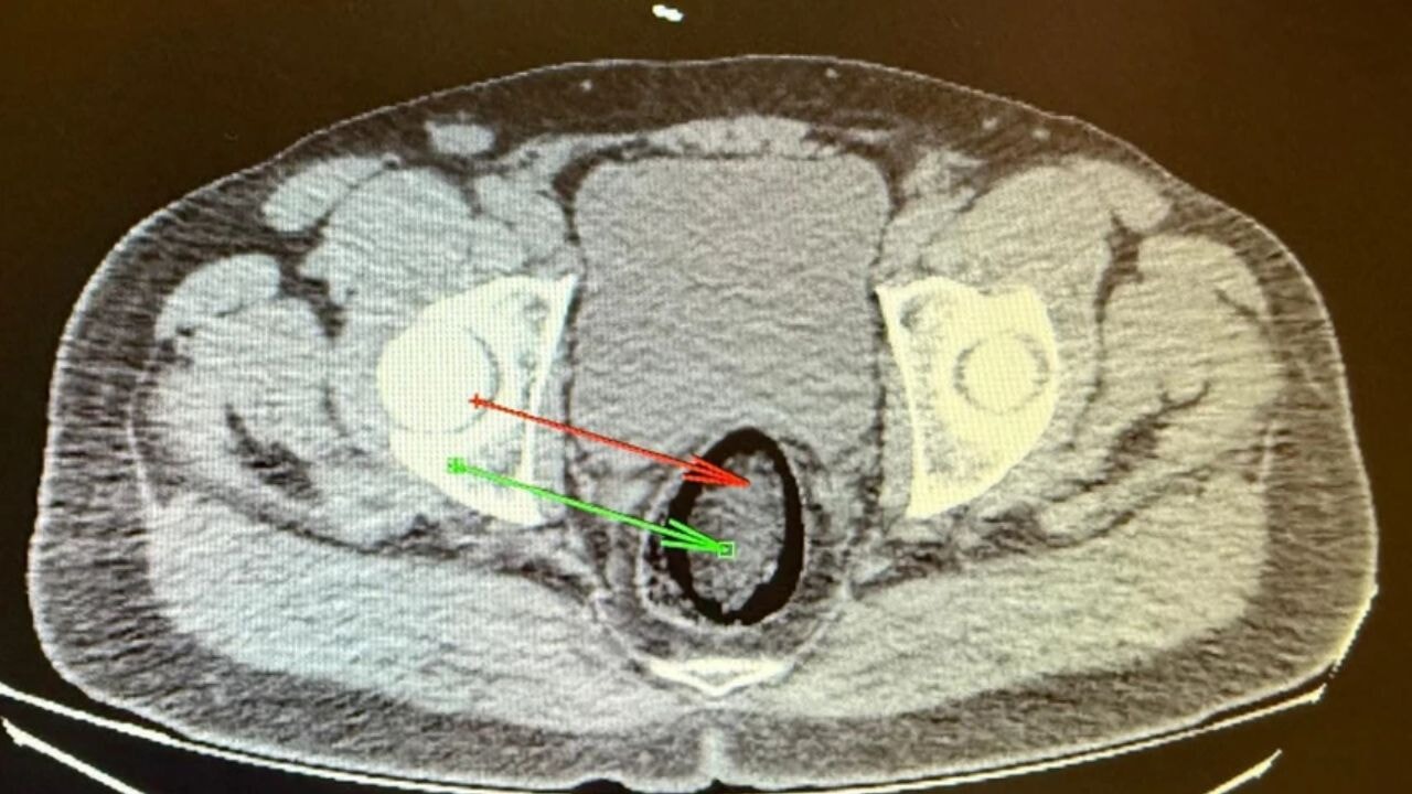 Polis şüphelendi, hastane ortaya çıkardı! Makatından uyuşturucu çıktı