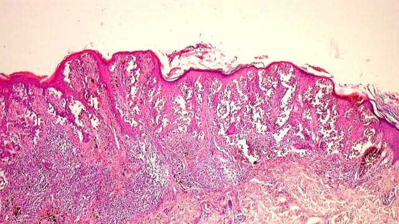 Cinsiyete göre vücutta yayılan kanser: Melanom